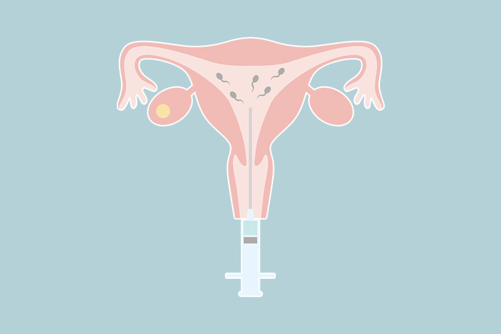 Intrauterine Insemination (IUI)